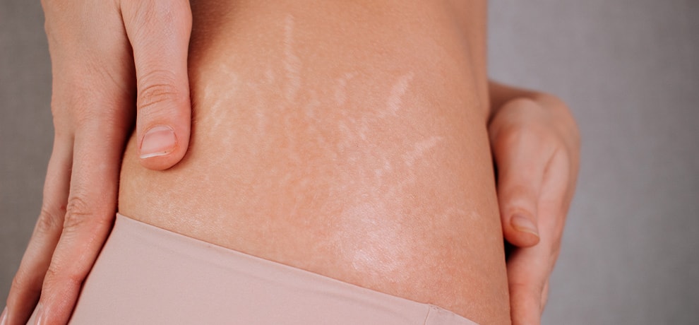 Aceite esencial para las estrías: ¿cuáles elegir y cómo utilizarlos?