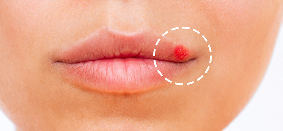 Herpes labial: ¿cómo tratarlo de forma natural?