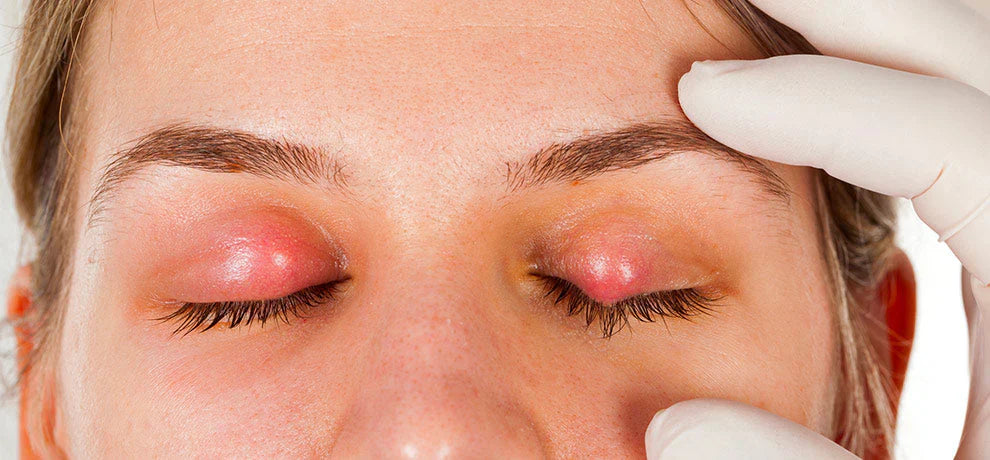 Orzuelo: ¿cómo tratarlo de forma natural?