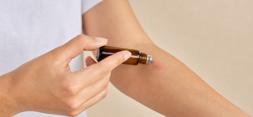 Alergia a la picadura de mosquito: reconocer y calmar naturalmente