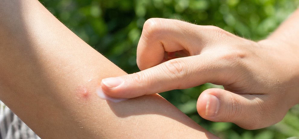 Alergia a la picadura de mosquito tigre: reconocerla y aliviarla