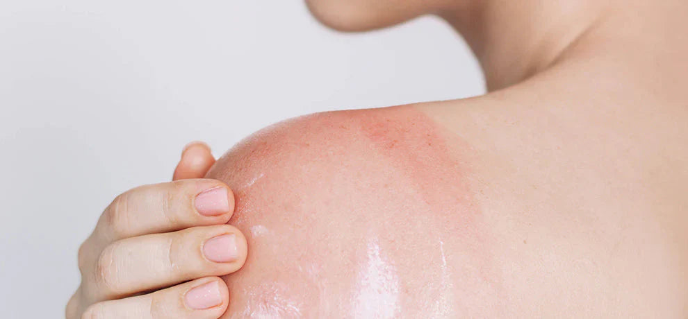 Aceites esenciales y quemaduras solares: aliviarlas de forma natural