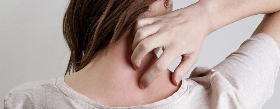 Tratar el eccema con aceites esenciales